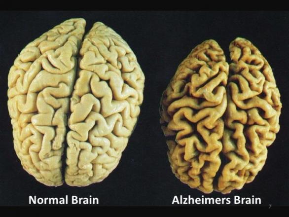 Alzheimerova choroba způsobuje degenerativní onemocnění mozku. Díky ní staří lidé přichází o paměť a kognitivní schopnosti.