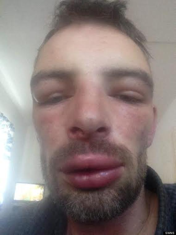 Napuchlý soused, který napuchnul na sluníčku, svádí svou napuchlost na včely