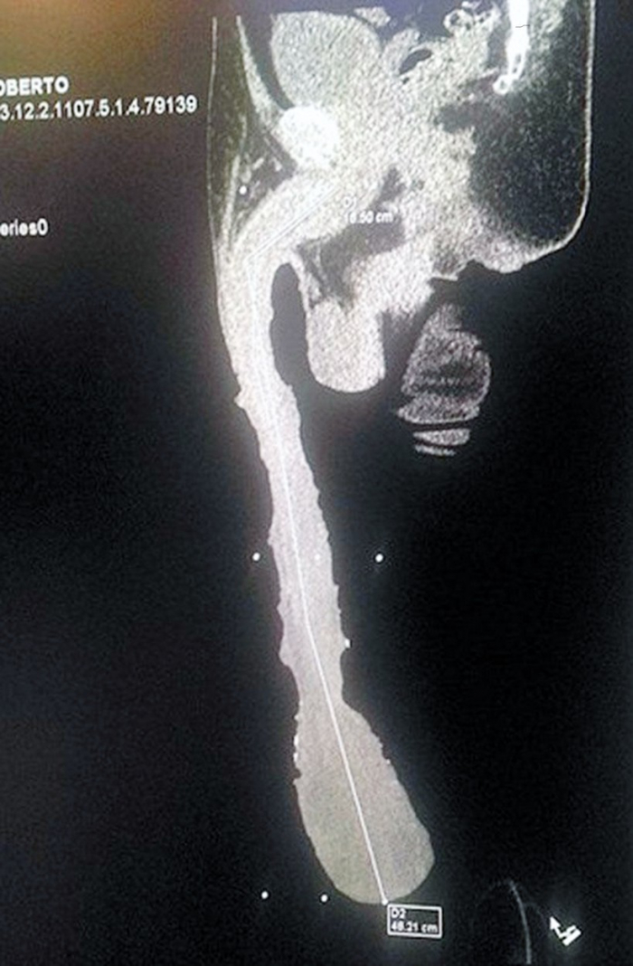 Jeden z rentgenových snímků Cabrerova penisu i s ‚příslušenstvím‘