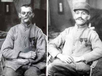 Na první pohled se může zdát, že se jedná o dvě rozličné osoby. Na druhém snímku stejný voják s maskou. Zranění obličeje byla velmi častá, neboť vojáci museli čas od času vystrčit ze zákopu hlavu, aby se rozhlédli.